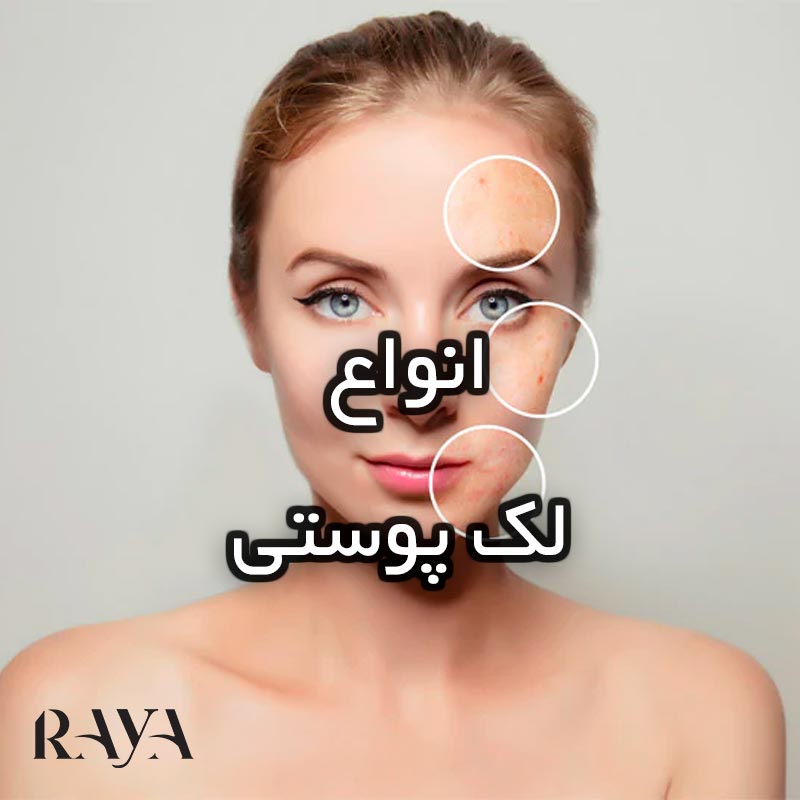 انواع لک های پوستی و درمان آن ها 